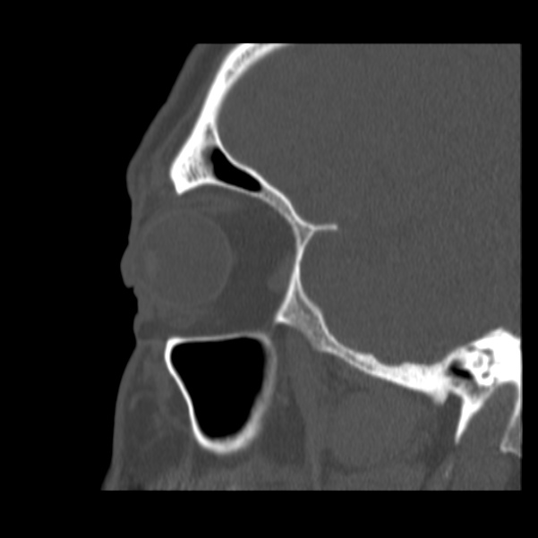 Acute sinusitis (Radiopaedia 23161-23215 Sagittal bone window 16).jpg
