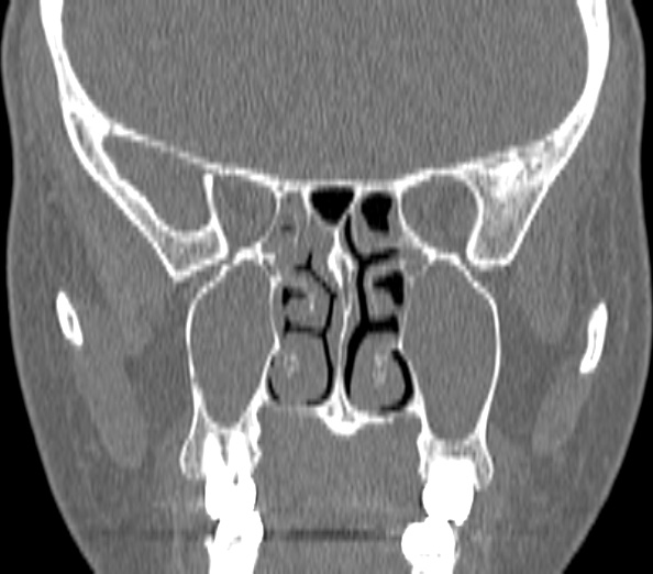 Acute sinusitis (Radiopaedia 40564-43158 Coronal bone window 27).jpg