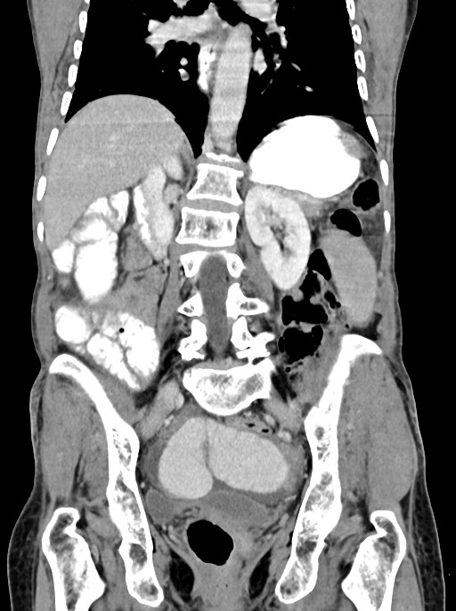 Acute small bowel (ileal) volvulus (Radiopaedia 71740-82139 Coronal C+ portal venous phase 73).jpg