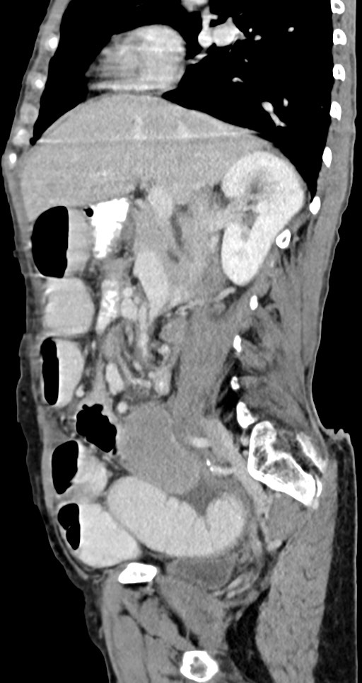 Acute small bowel (ileal) volvulus (Radiopaedia 71740-82139 Sagittal C+ portal venous phase 104).jpg