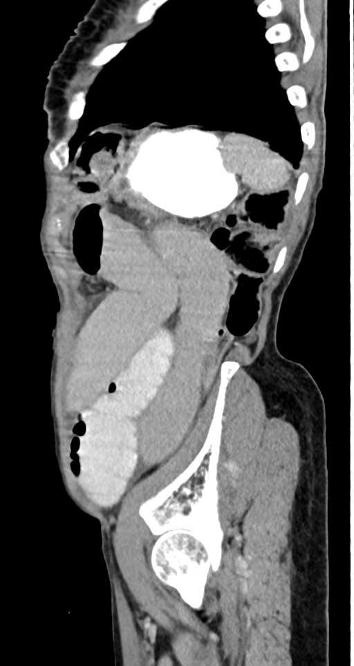 Acute small bowel (ileal) volvulus (Radiopaedia 71740-82139 Sagittal C+ portal venous phase 42).jpg