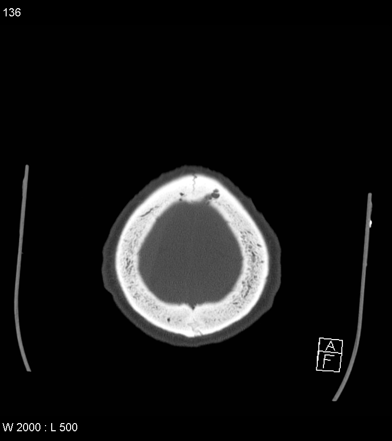 Acute subdural hematoma with myelofibrosis (Radiopaedia 52582-58494 Axial bone window 68).jpg