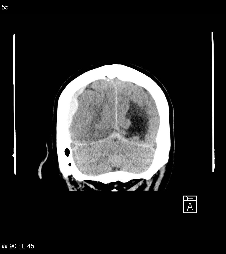Acute subdural hematoma with myelofibrosis (Radiopaedia 52582-58494 Coronal non-contrast 46).jpg