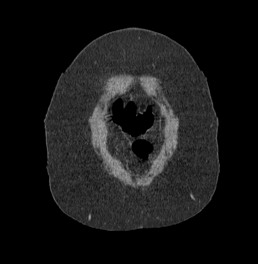 Acute superior mesenteric artery occlusion (Radiopaedia 51288-56960 Coronal C+ portal venous phase 4).jpg