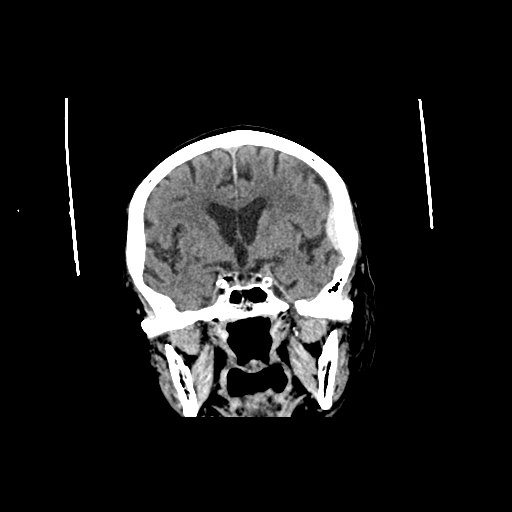 File:Acute traumatic subdural hematoma (Radiopaedia 82921-97257 Axial non-contrast 1).jpg