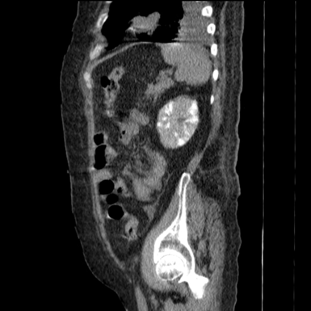 Acute tubular necrosis (Radiopaedia 28077-28334 Sagittal non-contrast 67).jpg