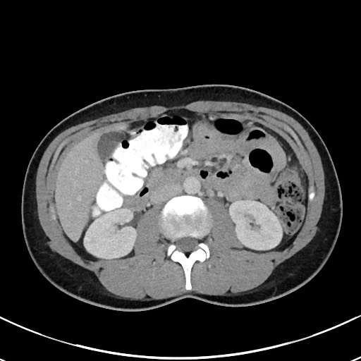 File:Acute uncomplicated appendicitis (Radiopaedia 61374-69304 Axial C+ portal venous phase 48).jpg