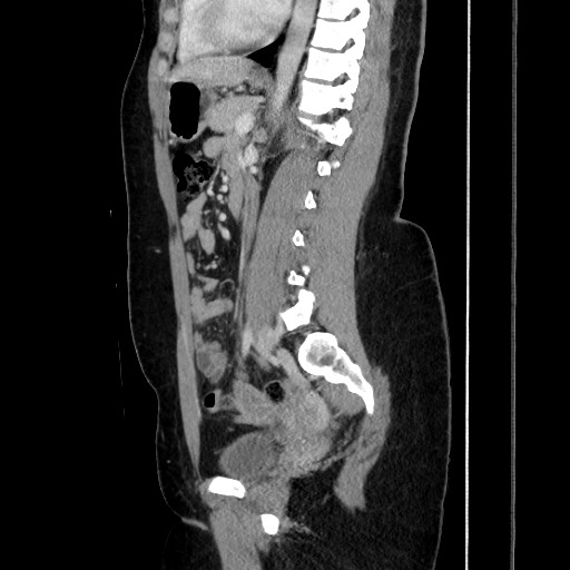 Acute uncomplicated appendicitis (Radiopaedia 73704-84499 Sagittal C+ portal venous phase 126).jpg