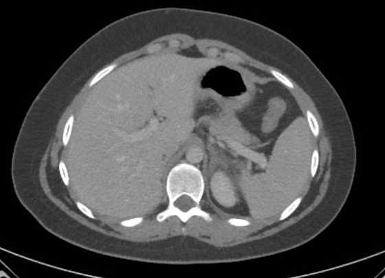 Acute unilateral nonhemorrhagic adrenal infarction (Radiopaedia 67560-76957 Axial renal parenchymal phase 18).jpg