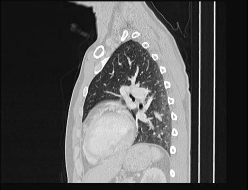 Addison disease (Radiopaedia 49318-54412 Sagittal lung window 21).jpg