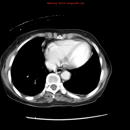 Adenocarcinoma of the colon (Radiopaedia 8191-9039 Axial liver window 7).jpg