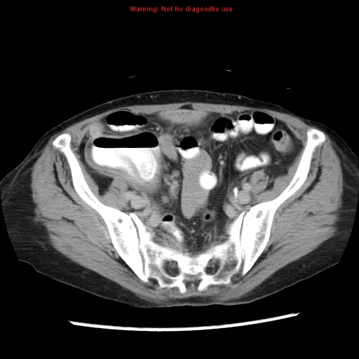 Adenocarcinoma of the colon (Radiopaedia 8191-9039 Axial renal excretory phase 44).jpg