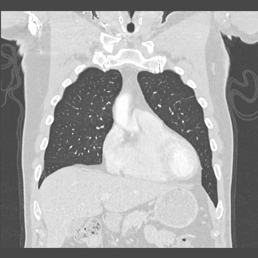 Adenocarcinoma of the lung (Radiopaedia 59871-67325 Coronal lung window 12).jpg