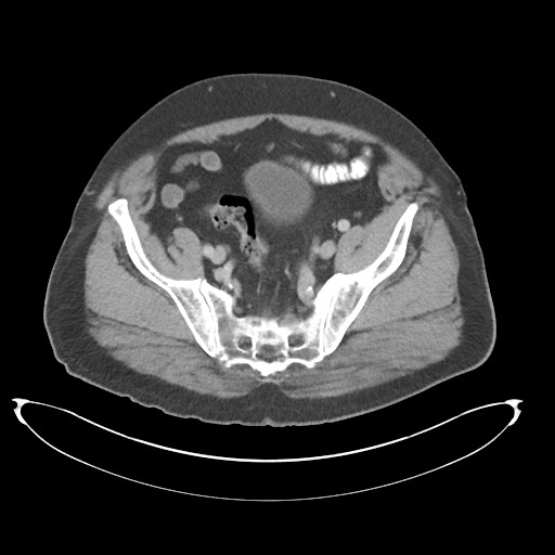 Adenocarcioma of rectum- T1 lesion (Radiopaedia 36921-38547 Axial C+ portal venous phase 71).png