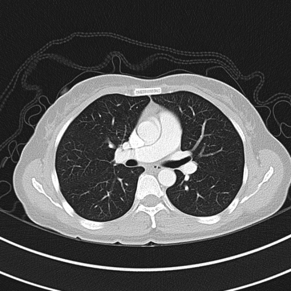 Adenocystic carcinoma of the trachea (Radiopaedia 47677-52525 Axial lung window 50).jpg