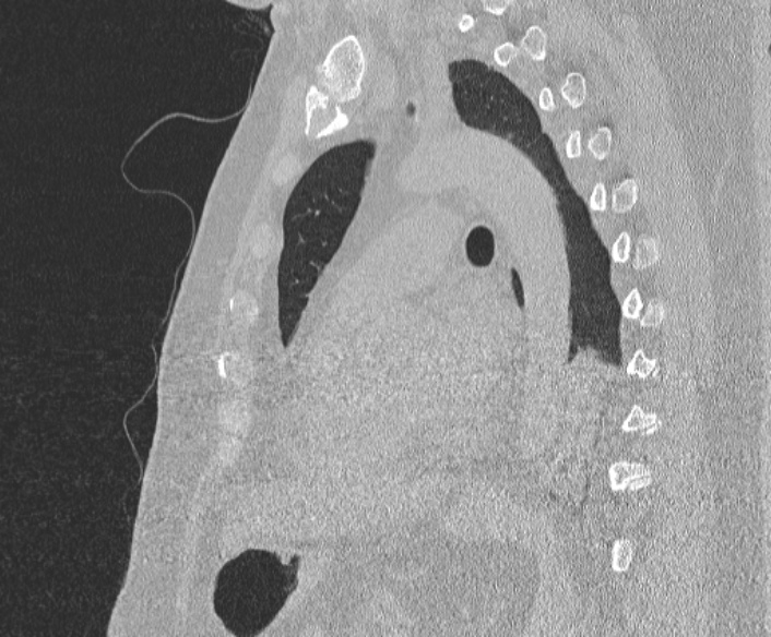 Adenoid cystic carcinoma of the trachea (Radiopaedia 49042-54137 Sagittal lung window 275).jpg