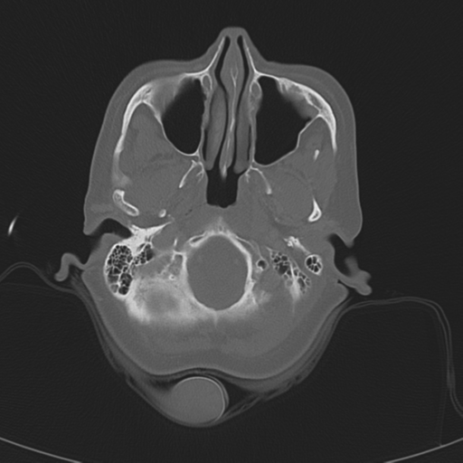 Adenoid cystic tumor of palate (Radiopaedia 46980-51518 Axial bone window 20).png
