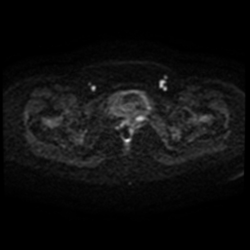 Adenoma malignum of cervix (Radiopaedia 66441-75705 Axial DWI 70).jpg