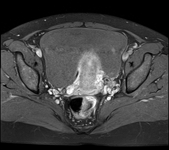 File:Adenomyosis - ovarian endometriomas (Radiopaedia 67031-76350 Axial T1 C+ fat sat 17).jpg