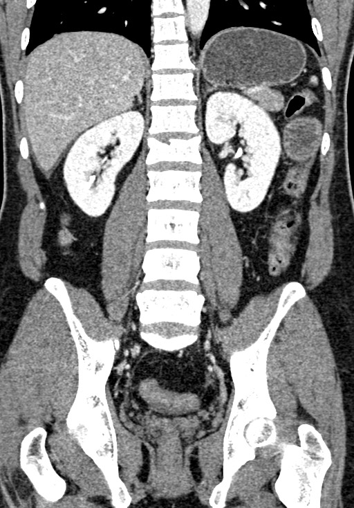 Adhesional small bowel obstruction (Radiopaedia 58900-66131 Coronal C+ portal venous phase 171).jpg