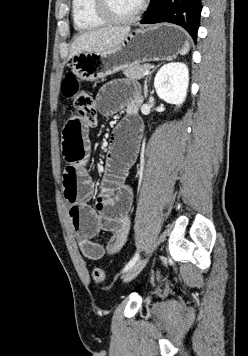 Adhesional small bowel obstruction (Radiopaedia 58900-66131 Sagittal C+ portal venous phase 159).jpg