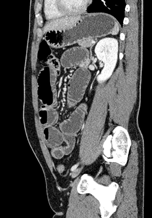 Adhesional small bowel obstruction (Radiopaedia 58900-66131 Sagittal C+ portal venous phase 164).jpg