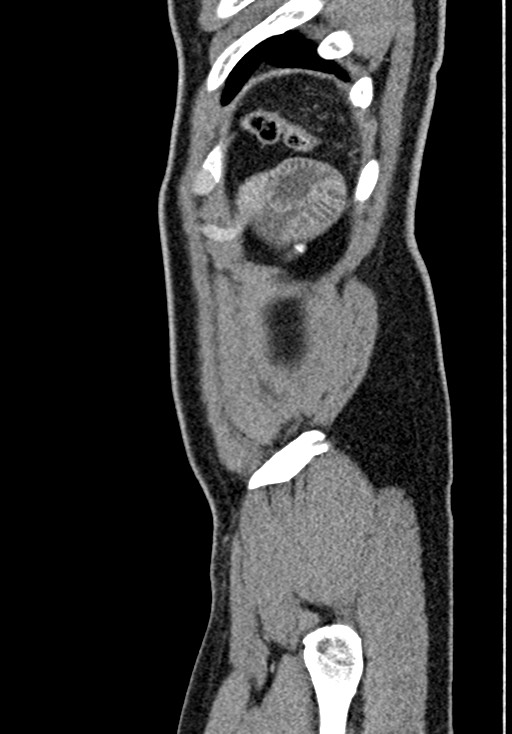 Adhesional small bowel obstruction (Radiopaedia 58900-66131 Sagittal C+ portal venous phase 231).jpg