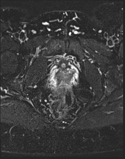 File:Adnexal multilocular cyst (O-RADS US 3- O-RADS MRI 3) (Radiopaedia 87426-103754 Axial T2 fat sat 21).jpg