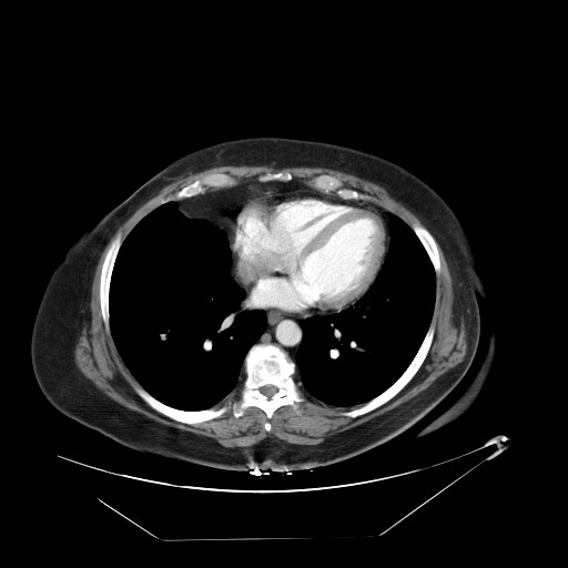 Adrenal angiosarcoma (Radiopaedia 81081-94671 Axial C+ arterial phase 2).jpg
