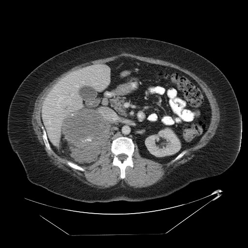 Adrenal angiosarcoma (Radiopaedia 81081-94671 Axial C+ portal venous phase 30).jpg