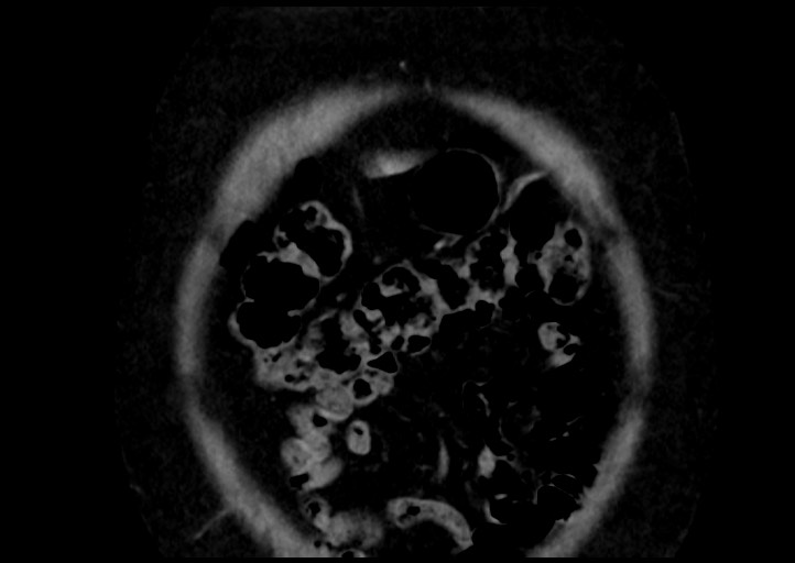 Adrenal cortical carcinoma (Radiopaedia 64017-72769 Coronal C+ portal venous phase 6).jpg