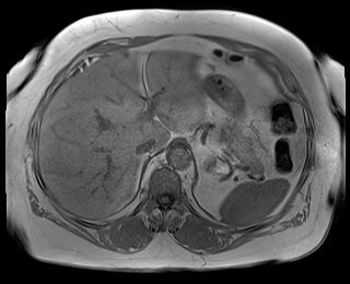 File:Adrenal cortical carcinoma (Radiopaedia 64017-72770 Axial T1 in-phase 16).jpg