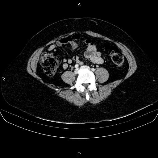 Adrenal cortical carcinoma (Radiopaedia 84882-100379 Axial C+ portal venous phase 60).jpg