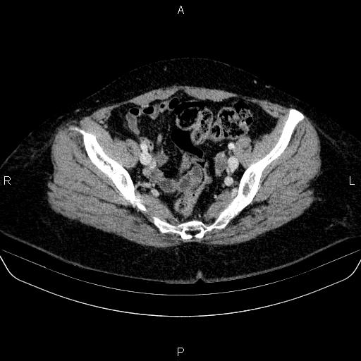 Adrenal cortical carcinoma (Radiopaedia 84882-100379 Axial C+ portal venous phase 80).jpg