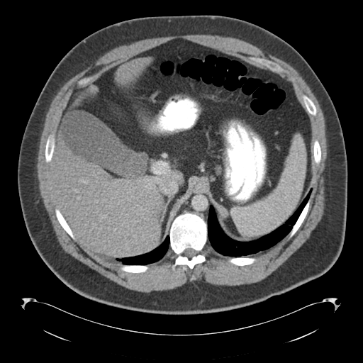 Adrenal cyst (Radiopaedia 45625-49776 Axial C+ portal venous phase 26).png