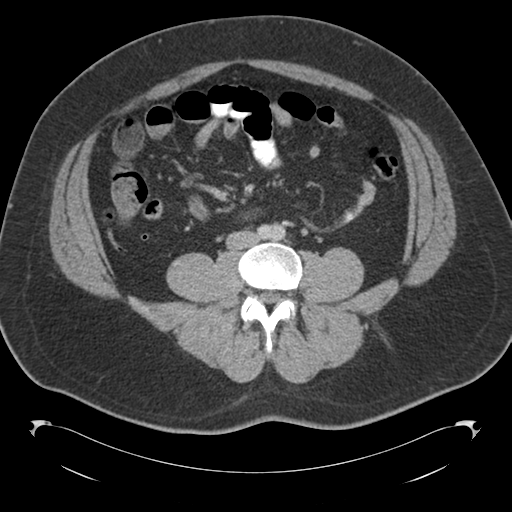Adrenal cyst (Radiopaedia 45625-49776 Axial C+ portal venous phase 59).png