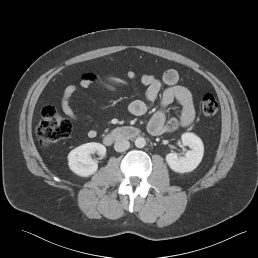 File:Adrenal cyst (Radiopaedia 45625-49777 Axial C+ portal venous phase 50).png