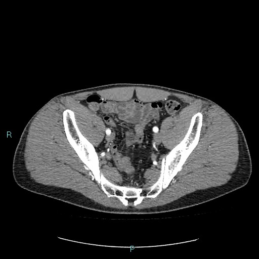 Adrenal cystic lymphangioma (Radiopaedia 83161-97534 Axial C+ arterial phase 81).jpg