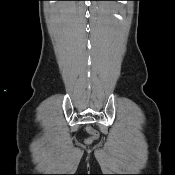 Adrenal cystic lymphangioma (Radiopaedia 83161-97534 Coronal C+ portal venous phase 69).jpg