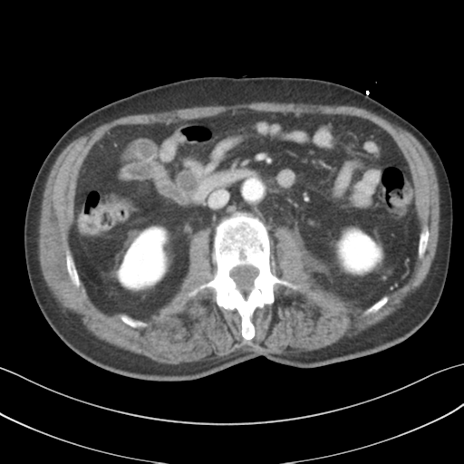 File:Adrenal hematoma (Radiopaedia 44334-47968 Axial C+ portal venous phase 37).png