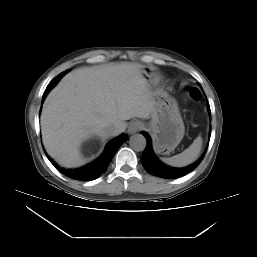 File:Adrenal myelolipoma (Radiopaedia 41843-44834 Axial non-contrast 4).jpg