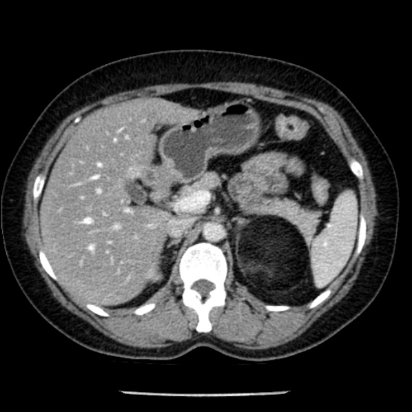 Adrenal myelolipoma (Radiopaedia 43401-46759 Axial C+ portal venous phase 26).jpg