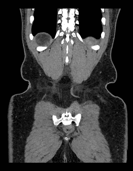 Adrenal myelolipoma - bilateral (Radiopaedia 74805-85810 Coronal C+ portal venous phase 65).jpg