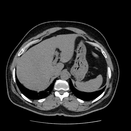 Adrenal myelolipoma and beaver tail liver (Radiopaedia 86201-102193 Axial non-contrast 89).jpg