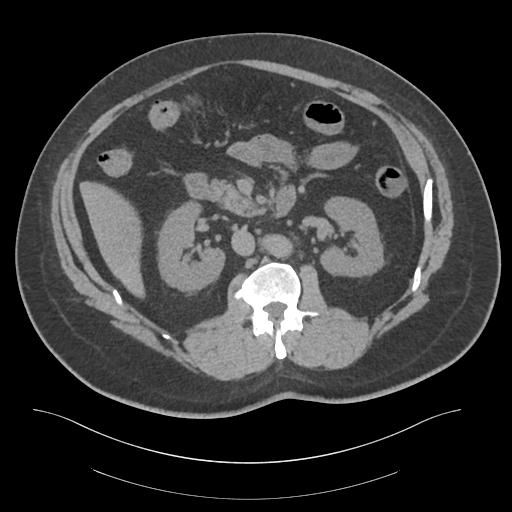 File:Adrenal vein sampling and adrenal nodular hyperplasia - Conn syndrome (Radiopaedia 30561-31337 Axial non-contrast 37).jpg