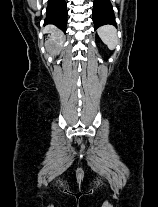 Adrenocortical carcinoma (Radiopaedia 87281-103569 Coronal C+ portal venous phase 133).jpg