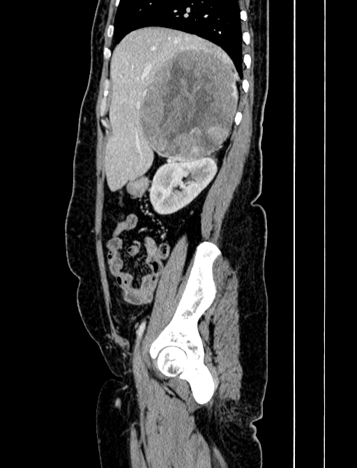 Adrenocortical carcinoma (Radiopaedia 87281-103569 Sagittal C+ portal venous phase 73).jpg