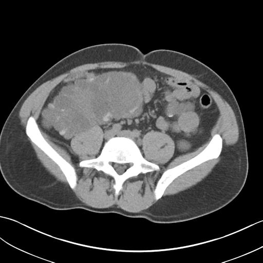 File:Adult polycystic kidney disease (Radiopaedia 47866-52626 Axial non-contrast 53).png