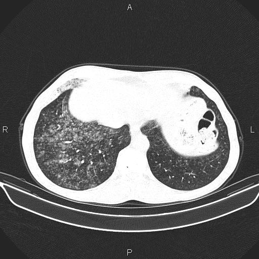 Air bronchogram in pneumonia (Radiopaedia 85719-101512 Axial lung window 55).jpg