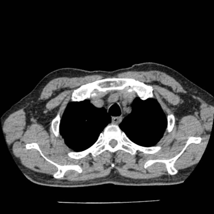 Airway foreign body in adult (Radiopaedia 85907-101779 Axial liver window 10).jpg